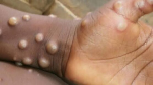 Ghana records first Mpox d£ath amid surge in cases